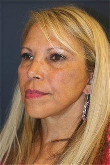 Facelift After Photo by Steve Laverson, MD, FACS; San Diego, CA - Case 47573