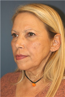 Facelift Before Photo by Steve Laverson, MD, FACS; San Diego, CA - Case 47573