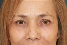 Eyelid Surgery After Photo by Steve Laverson, MD, FACS; Rancho Santa Fe, CA - Case 47689