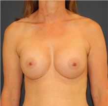 Breast Augmentation After Photo by Steve Laverson, MD, FACS; Rancho Santa Fe, CA - Case 47691