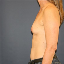 Breast Augmentation Before Photo by Steve Laverson, MD, FACS; Rancho Santa Fe, CA - Case 47691