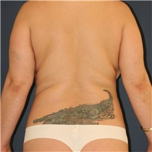 Liposuction Before Photo by Steve Laverson, MD, FACS; San Diego, CA - Case 47692