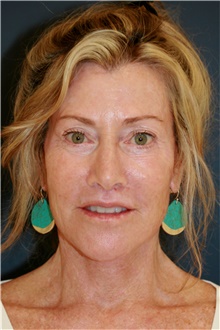 Facelift After Photo by Steve Laverson, MD, FACS; Rancho Santa Fe, CA - Case 47828