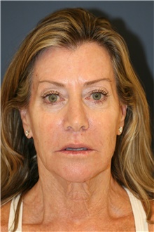 Facelift Before Photo by Steve Laverson, MD, FACS; Rancho Santa Fe, CA - Case 47828