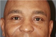 Eyelid Surgery After Photo by Steve Laverson, MD, FACS; San Diego, CA - Case 47841