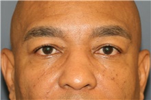 Eyelid Surgery Before Photo by Steve Laverson, MD, FACS; Rancho Santa Fe, CA - Case 47841