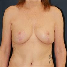 Breast Lift After Photo by Steve Laverson, MD, FACS; Rancho Santa Fe, CA - Case 47900