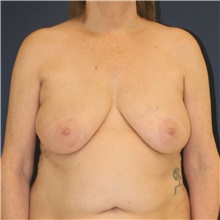Breast Lift Before Photo by Steve Laverson, MD, FACS; San Diego, CA - Case 47900