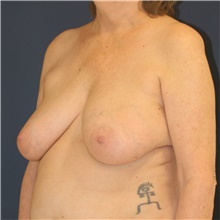 Breast Lift Before Photo by Steve Laverson, MD, FACS; Rancho Santa Fe, CA - Case 47900