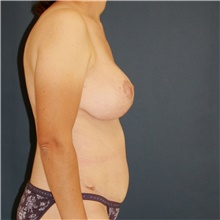 Mommy Makeover After Photo by Steve Laverson, MD, FACS; Rancho Santa Fe, CA - Case 47901