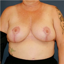 Breast Lift After Photo by Steve Laverson, MD, FACS; San Diego, CA - Case 47903