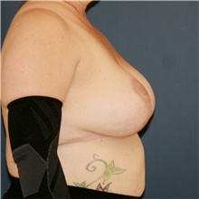 Breast Lift After Photo by Steve Laverson, MD, FACS; Rancho Santa Fe, CA - Case 47903
