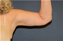 Arm Lift After Photo by Steve Laverson, MD, FACS; San Diego, CA - Case 47905