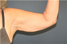 Arm Lift Before Photo by Steve Laverson, MD, FACS; Rancho Santa Fe, CA - Case 47905