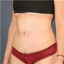 Tummy Tuck After Photo by Steve Laverson, MD, FACS; Rancho Santa Fe, CA - Case 47906