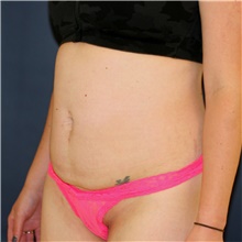 Tummy Tuck Before Photo by Steve Laverson, MD; San Diego, CA - Case 47906