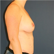 Breast Lift After Photo by Steve Laverson, MD; San Diego, CA - Case 47958