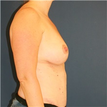 Breast Lift After Photo by Steve Laverson, MD, FACS; Rancho Santa Fe, CA - Case 47958