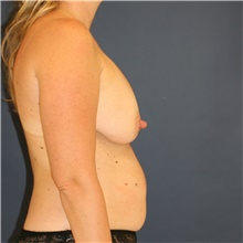 Breast Lift Before Photo by Steve Laverson, MD, FACS; Rancho Santa Fe, CA - Case 47958