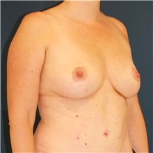 Breast Lift After Photo by Steve Laverson, MD, FACS; Rancho Santa Fe, CA - Case 47958