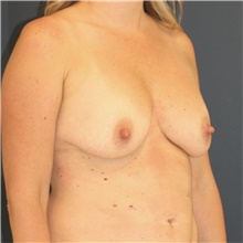 Breast Lift Before Photo by Steve Laverson, MD, FACS; Rancho Santa Fe, CA - Case 47958