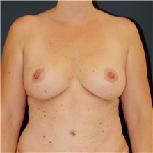 Breast Lift After Photo by Steve Laverson, MD, FACS; Rancho Santa Fe, CA - Case 47958