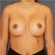 Breast Augmentation After Photo by Steve Laverson, MD; San Diego, CA - Case 48051