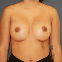 Breast Augmentation After Photo by Steve Laverson, MD, FACS; Rancho Santa Fe, CA - Case 48051