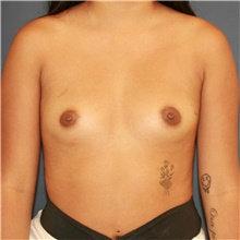 Breast Augmentation Before Photo by Steve Laverson, MD, FACS; Rancho Santa Fe, CA - Case 48051