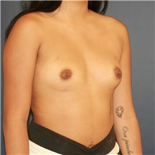 Breast Augmentation Before Photo by Steve Laverson, MD, FACS; Rancho Santa Fe, CA - Case 48051