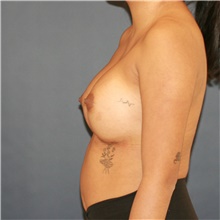 Breast Augmentation After Photo by Steve Laverson, MD, FACS; Rancho Santa Fe, CA - Case 48051