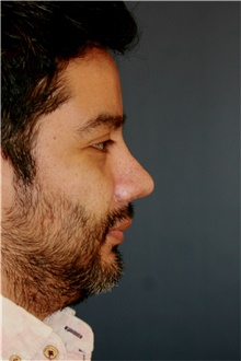 Rhinoplasty After Photo by Steve Laverson, MD, FACS; San Diego, CA - Case 48113