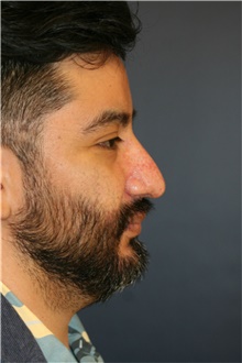 Rhinoplasty Before Photo by Steve Laverson, MD, FACS; San Diego, CA - Case 48113