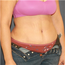 Tummy Tuck After Photo by Steve Laverson, MD, FACS; San Diego, CA - Case 48237