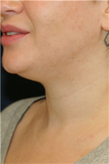 Liposuction Before Photo by Steve Laverson, MD, FACS; San Diego, CA - Case 48259