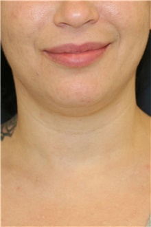 Liposuction Before Photo by Steve Laverson, MD, FACS; Rancho Santa Fe, CA - Case 48259