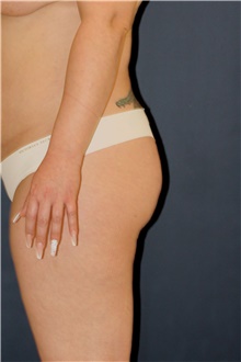 Buttock Lift with Augmentation Before Photo by Steve Laverson, MD, FACS; San Diego, CA - Case 48261