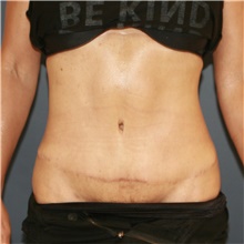 Tummy Tuck After Photo by Steve Laverson, MD, FACS; San Diego, CA - Case 48267