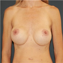 Breast Implant Revision Before Photo by Steve Laverson, MD, FACS; Rancho Santa Fe, CA - Case 48271