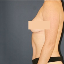Tummy Tuck After Photo by Steve Laverson, MD, FACS; San Diego, CA - Case 48286