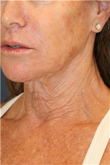 Neck Lift Before Photo by Steve Laverson, MD, FACS; San Diego, CA - Case 48292