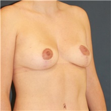 Breast Lift After Photo by Steve Laverson, MD, FACS; San Diego, CA - Case 48293