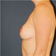 Breast Lift After Photo by Steve Laverson, MD, FACS; Rancho Santa Fe, CA - Case 48293