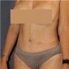Tummy Tuck After Photo by Steve Laverson, MD, FACS; San Diego, CA - Case 48294