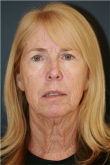 Facelift Before Photo by Steve Laverson, MD, FACS; San Diego, CA - Case 48296