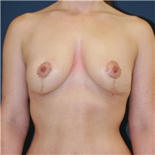 Breast Lift After Photo by Steve Laverson, MD, FACS; Rancho Santa Fe, CA - Case 48297