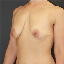Breast Lift Before Photo by Steve Laverson, MD, FACS; Rancho Santa Fe, CA - Case 48297