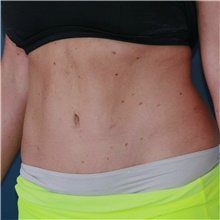 Tummy Tuck After Photo by Steve Laverson, MD, FACS; Rancho Santa Fe, CA - Case 49126