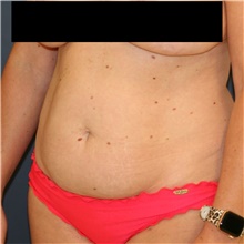 Tummy Tuck Before Photo by Steve Laverson, MD, FACS; Rancho Santa Fe, CA - Case 49126