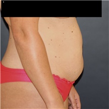 Tummy Tuck Before Photo by Steve Laverson, MD, FACS; Rancho Santa Fe, CA - Case 49126